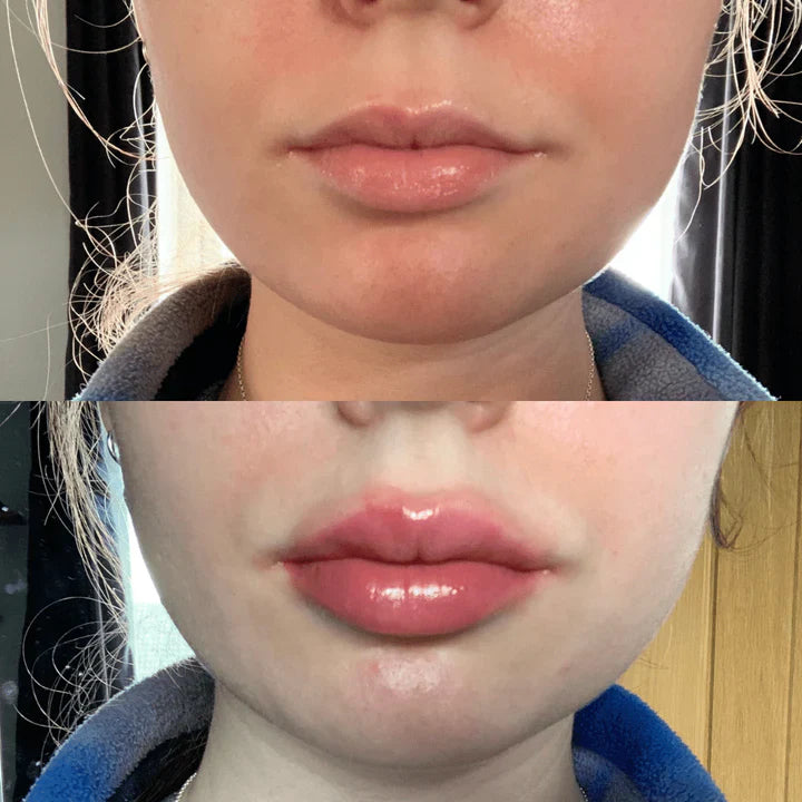 Plump It! No Needles Lip Filler Kit Original