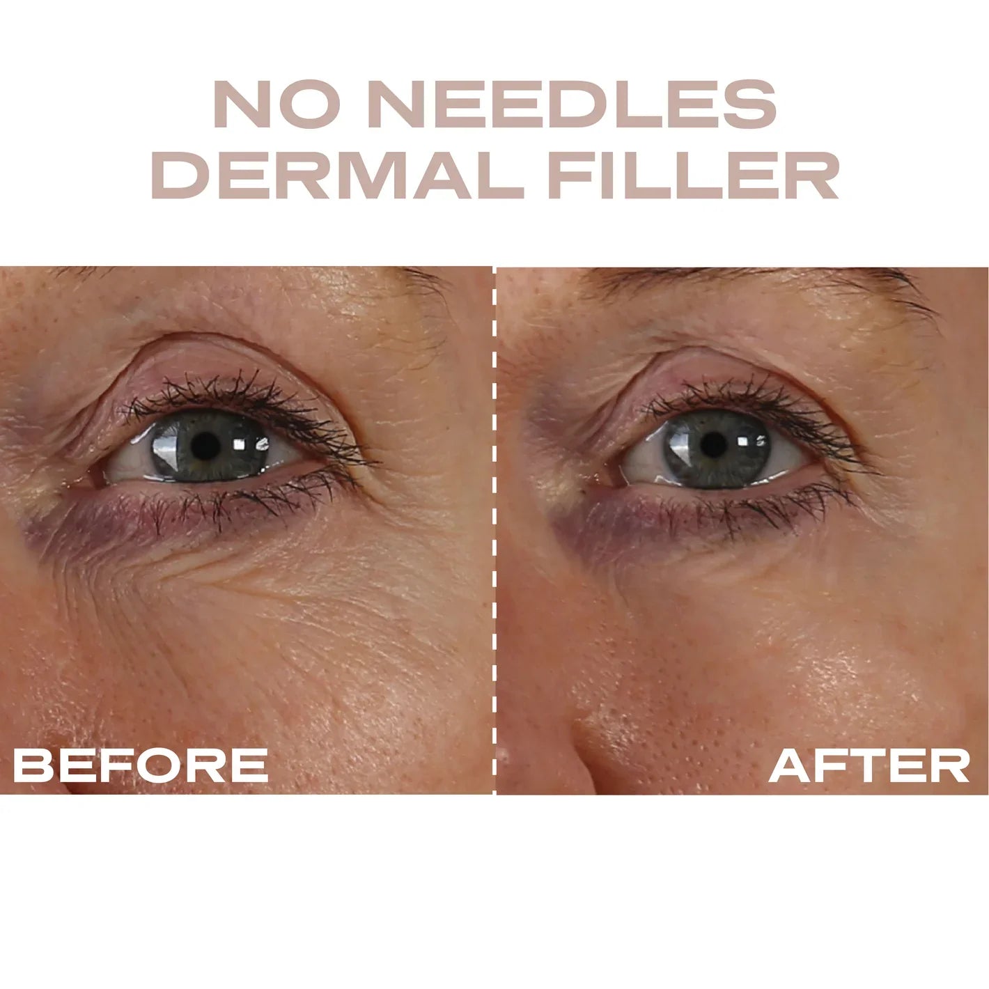 Plump It! No Needles Dermal Filler (30 applications)