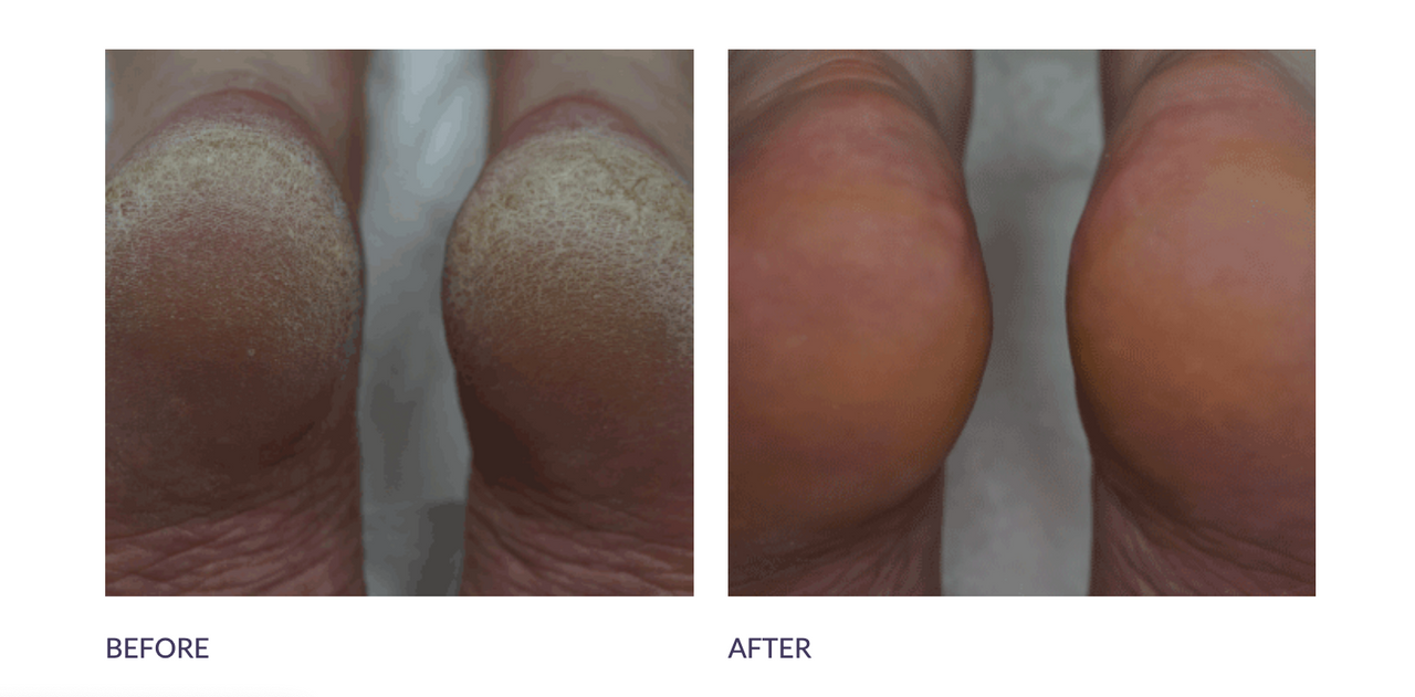 Footlogix Rough Skin 7+