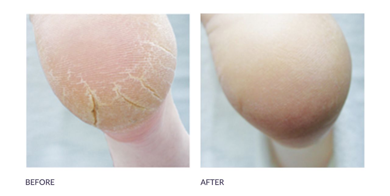 Footlogix Cracked Heel 3+