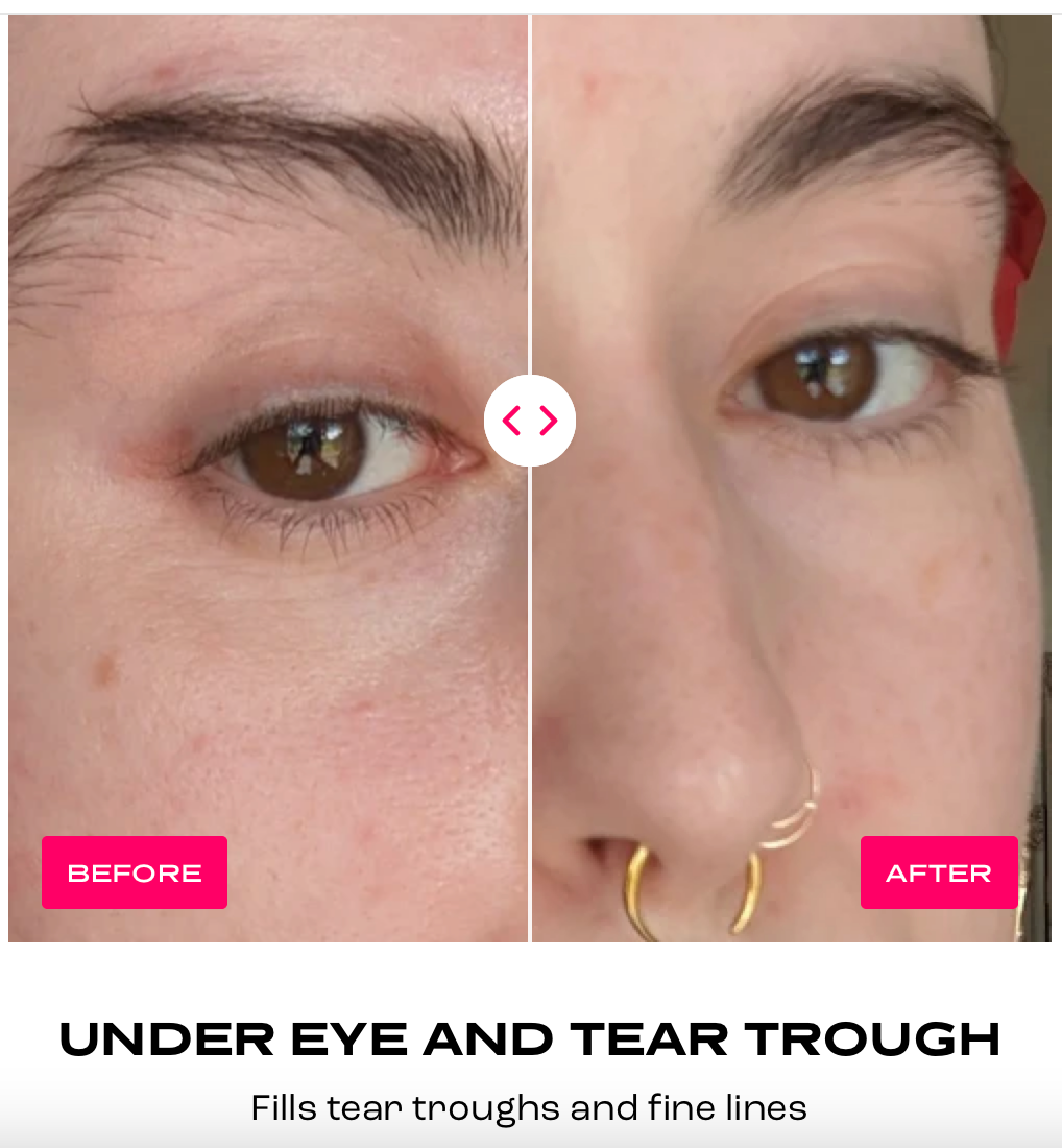 Plump It! No Needles Dermal Filler (30 applications)